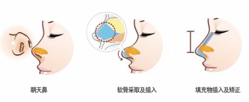 上海朝天鼻矫正大概要多少钱?