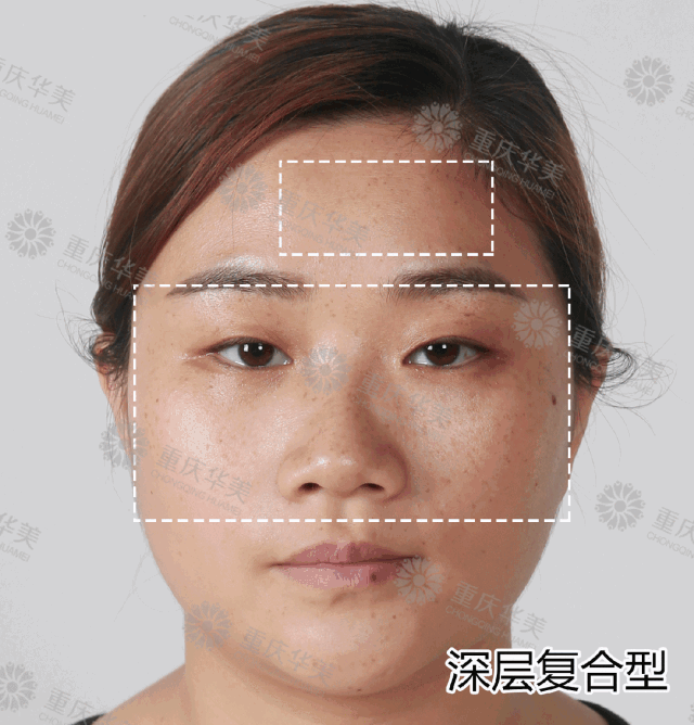 她祛斑get大白皮！你祛斑毁脸？区别就在这几点~