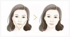 玻尿酸+注射瘦脸，柔美面部线条，打造高级小V脸~ width=