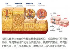 水动力吸脂手术有什么优势? width=