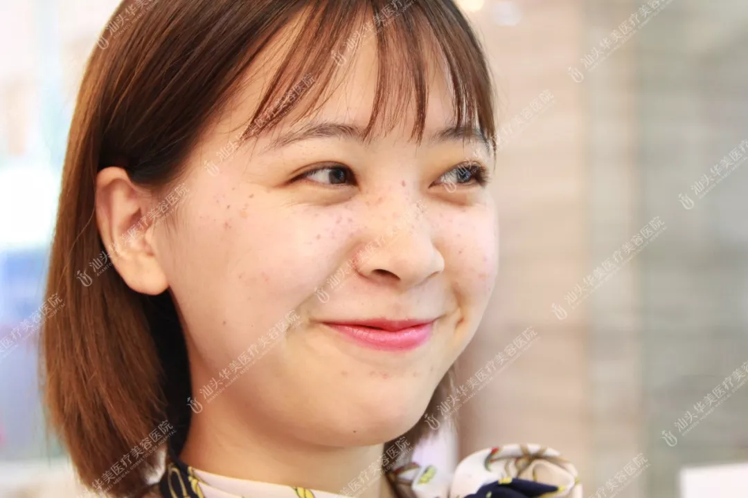 激光美肤激光祛斑好吗？激光美肤激光祛斑案例有没有给看一看~