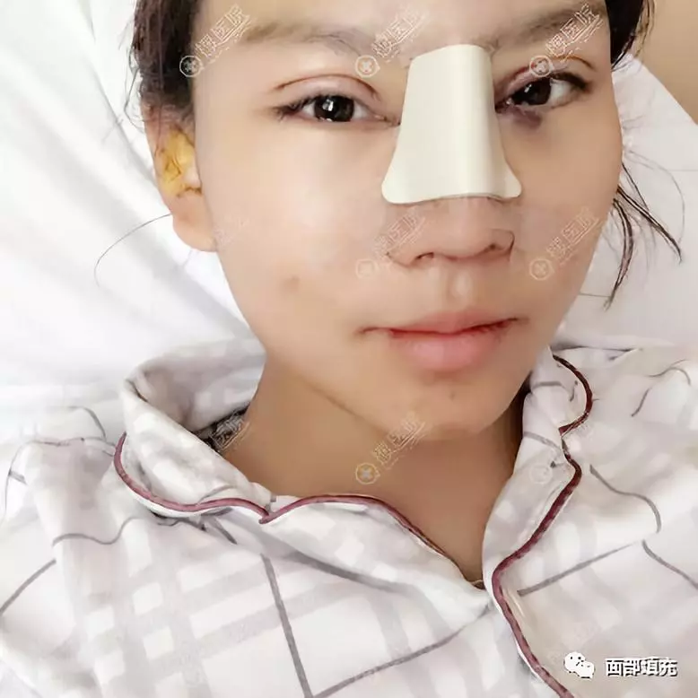 卢建医生在周六给我做了双眼皮隆鼻手术~