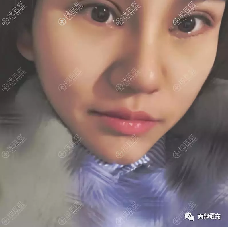 卢建医生在周六给我做了双眼皮隆鼻手术~