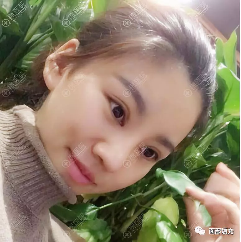 卢建医生在周六给我做了双眼皮隆鼻手术~