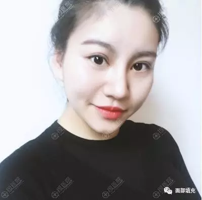 卢建医生在周六给我做了双眼皮隆鼻手术~