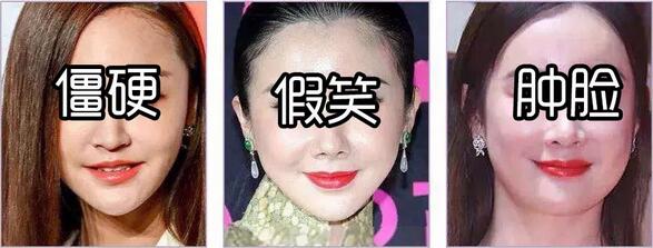 改造奚梦瑶同款凹陷脸，怎样填充得不露痕迹？