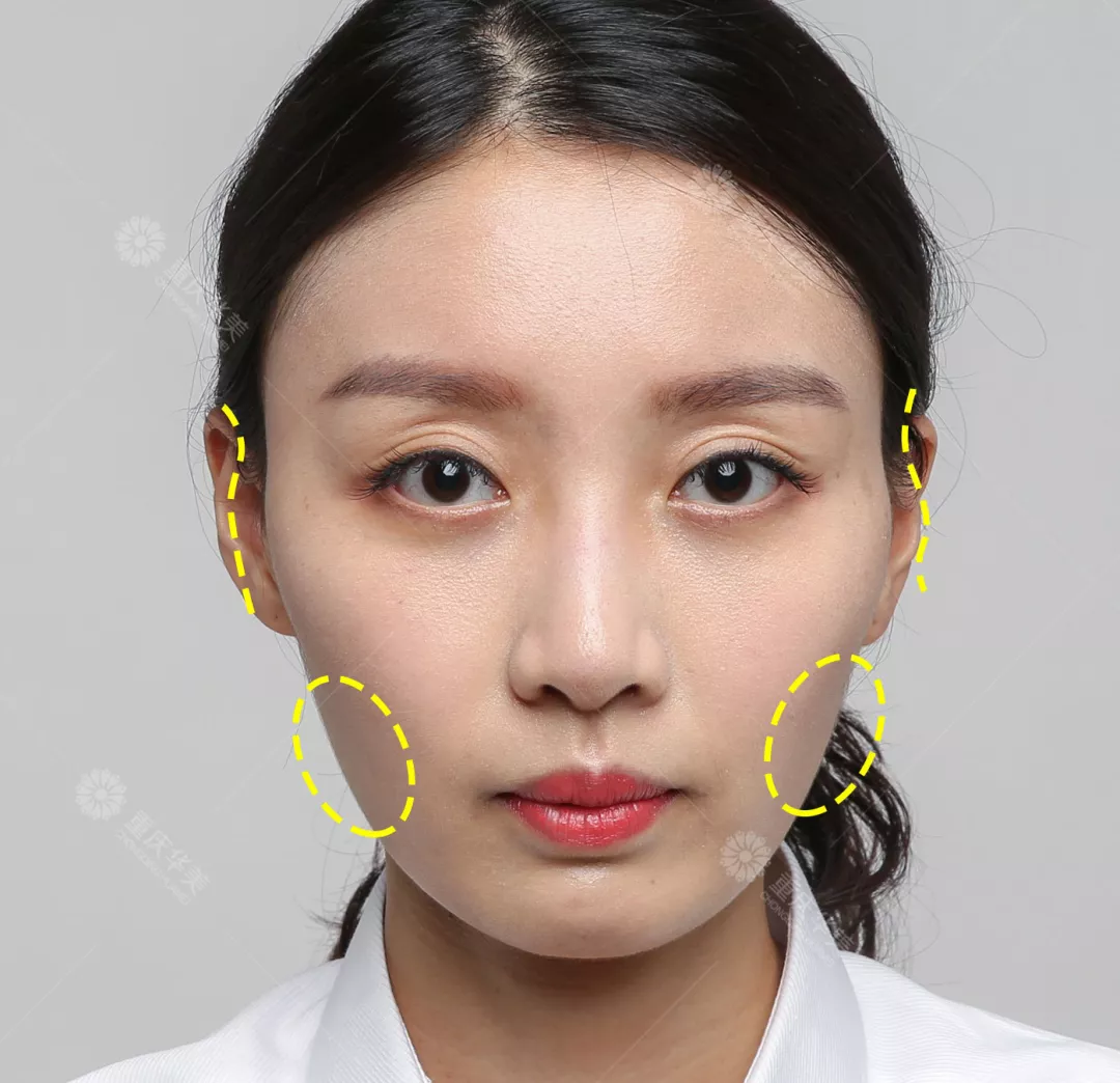 改造奚梦瑶同款凹陷脸，怎样填充得不露痕迹？