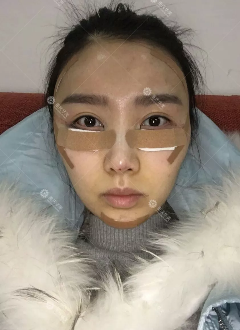 改造奚梦瑶同款凹陷脸，怎样填充得不露痕迹？