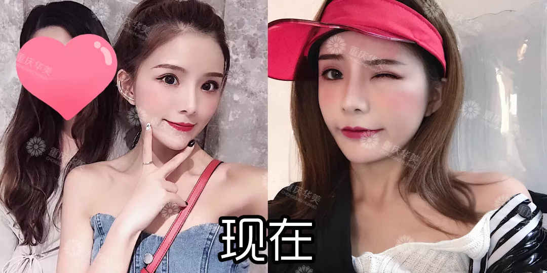 改造奚梦瑶同款凹陷脸，怎样填充得不露痕迹？