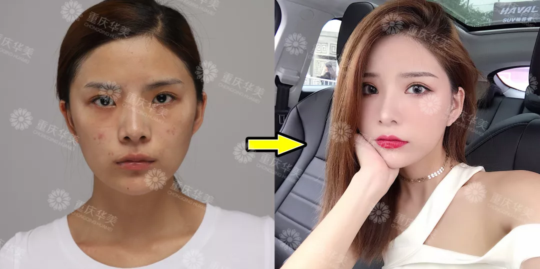 改造奚梦瑶同款凹陷脸，怎样填充得不露痕迹？