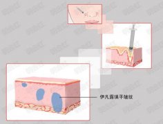 注射伊维兰除皱有后遗症吗? width=