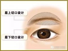 切眉手术后恢复期长吗 width=