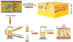 涨知识：自体脂肪移植可用于哪些部位的微整形? width=
