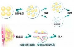 自体脂肪多了没用?那是没放对地方! width=