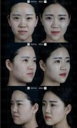 出色女性自白：玻尿酸才是我的变美好帮手！ width=