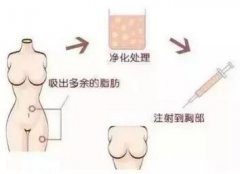 假体隆胸和自体脂肪丰胸到底哪个比较好？  width=