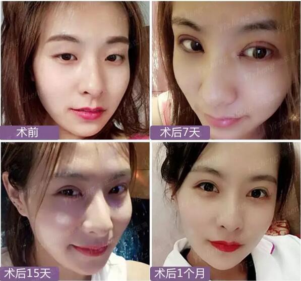 【到底什么是“Eyestar星眸动态双眼皮”夏院长亲自为您解答！】
