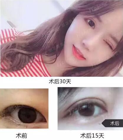 【到底什么是“Eyestar星眸动态双眼皮”夏院长亲自为您解答！】