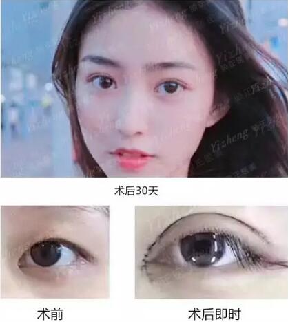 【到底什么是“Eyestar星眸动态双眼皮”夏院长亲自为您解答！】