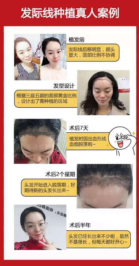 人工植发多少钱？有危害吗？什么问答都可以来问我哦~
