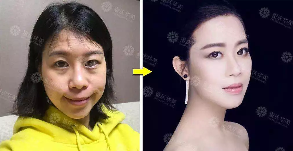 干瘪显老脸秒“换头”，玻尿酸+注射瘦脸 381元抢购~