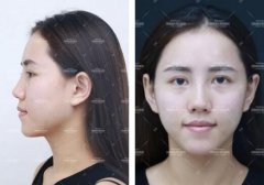 全肋隆鼻、半肋隆鼻到底该怎么选？ width=