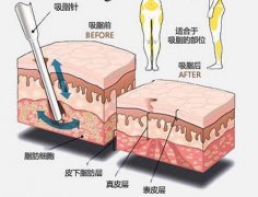 产后好身材不再?快去做妈咪整容术 width=