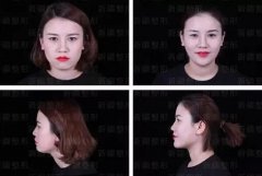 玻尿酸美容除皱的果好吗？来看看这些图片哦~ width=