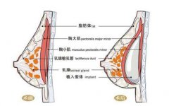 做曼托圆盘假体隆胸需要注意哪些? width=
