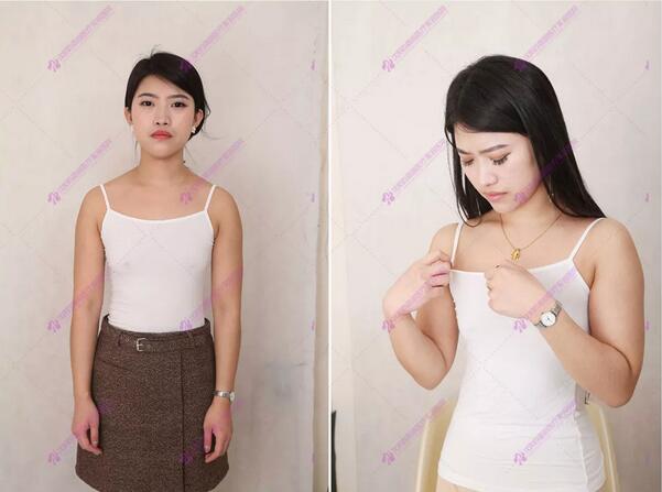 【膨体隆鼻整形有后遗症？不存在的，哈哈哈，来看看吧~】