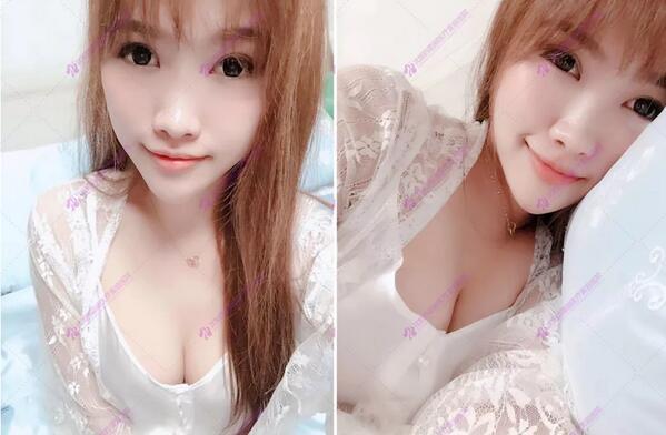 【膨体隆鼻整形有后遗症？不存在的，哈哈哈，来看看吧~】