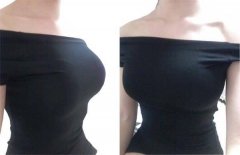 做若伊尔假体隆胸需要多久恢复? width=