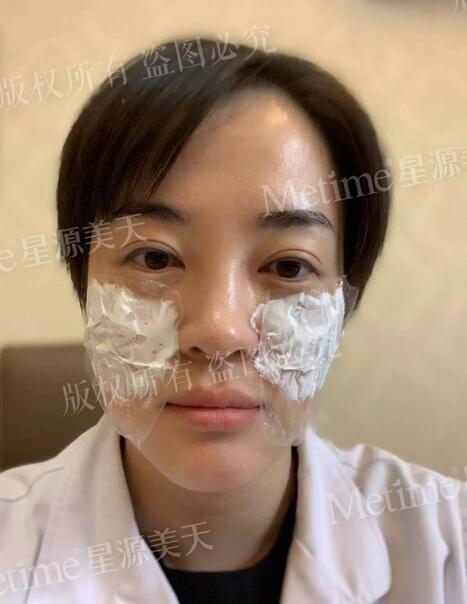 【自体脂肪填充苹果肌好还是用玻尿酸更好？我来给你们好好上一课~】
