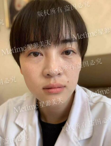 【自体脂肪填充苹果肌好还是用玻尿酸更好？我来给你们好好上一课~】