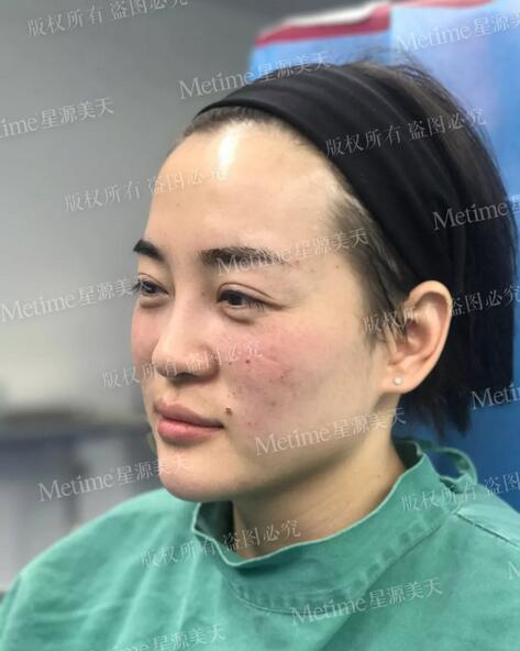 【自体脂肪填充苹果肌好还是用玻尿酸更好？我来给你们好好上一课~】