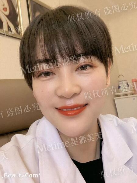 【自体脂肪填充苹果肌好还是用玻尿酸更好？我来给你们好好上一课~】