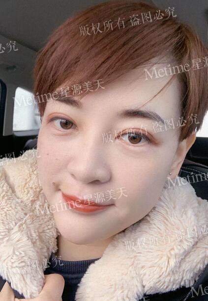 【自体脂肪填充苹果肌好还是用玻尿酸更好？我来给你们好好上一课~】