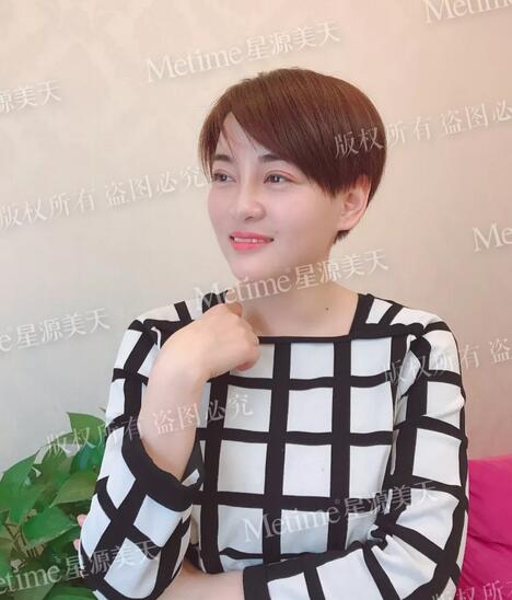 【自体脂肪填充苹果肌好还是用玻尿酸更好？我来给你们好好上一课~】