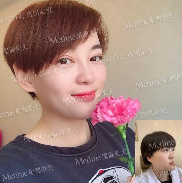 【自体脂肪填充苹果肌好还是用玻尿酸更好？我来给你们好好上一课~】
