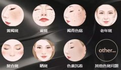 如何祛日晒斑呢？小编查了资料就给你说哈~ width=