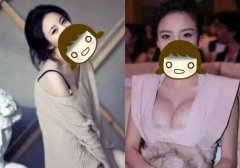 水滴型假体隆胸的果究竟有多妙，来看看这些真实案例哟~ width=