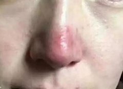 聊城东昌府区人民医院：诊治酒糟鼻的妙招有哪些? width=