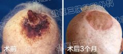 皮角是个啥子鬼哟？听都没有听斗过，北医三院Tell You！ width=