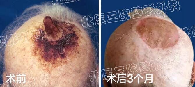 【皮角是个啥子鬼哟？听都没有听斗过，北医三院Tell You！】