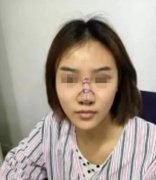 感谢南阳艾美陈保国给我做的耳软骨隆鼻 术后果很自然 width=