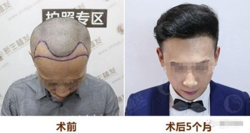 【上海植发医院哪家好？不知道这个问题有人帮忙解答下没？！】