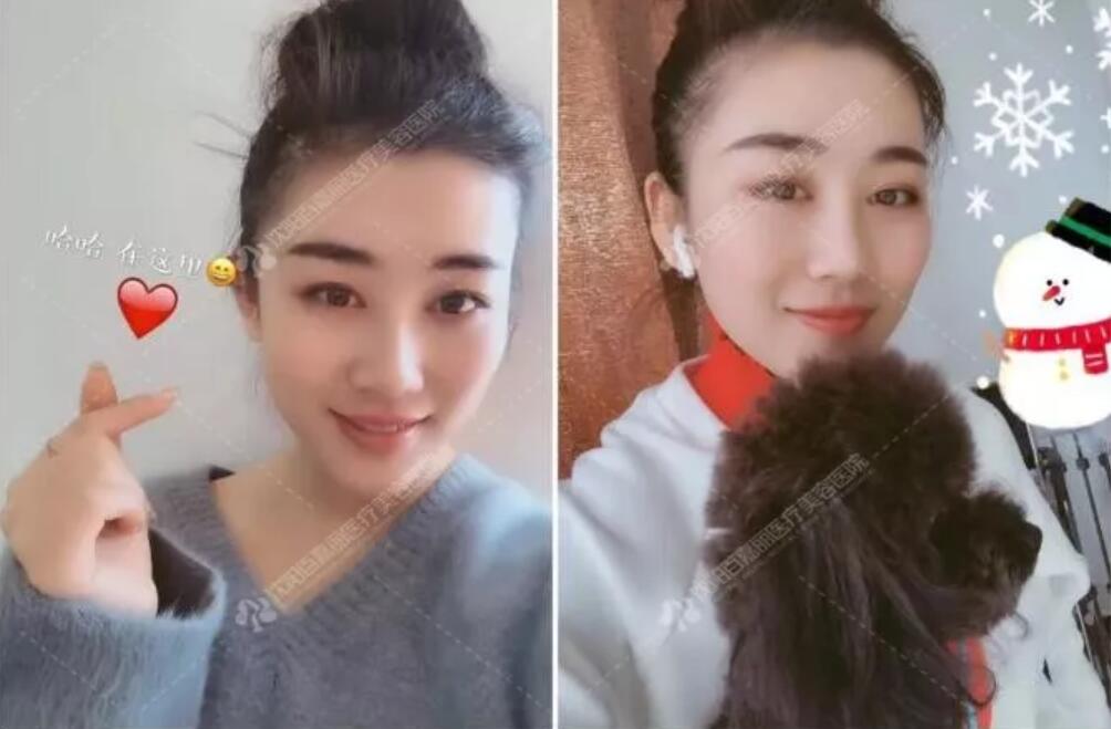 【鼻部手术整形价格要how much？下面这条真实案例tells you！】