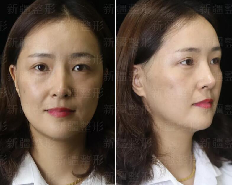 SVF-gel脂肪胶面部填充果真的很好吗？来看看这个案例吧！