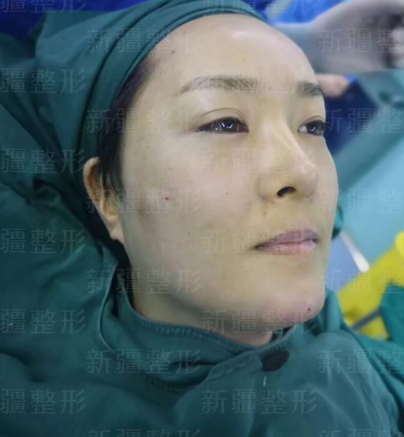 SVF-gel脂肪胶面部填充果真的很好吗？来看看这个案例吧！