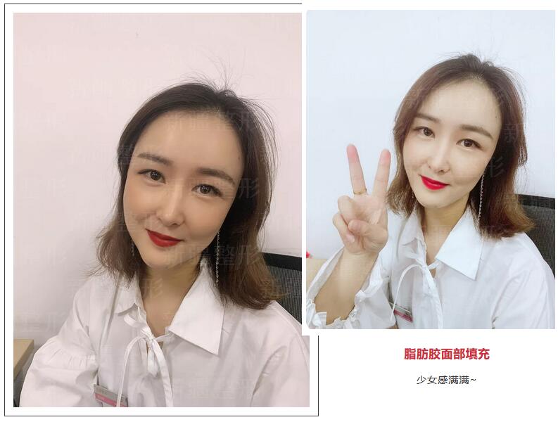 SVF-gel脂肪胶面部填充果真的很好吗？来看看这个案例吧！